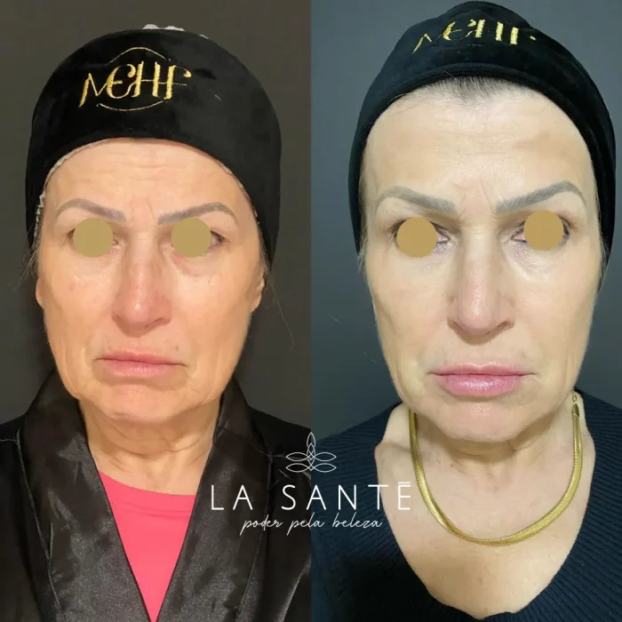Botox, olheiras, mandíbula, SNG, lábio